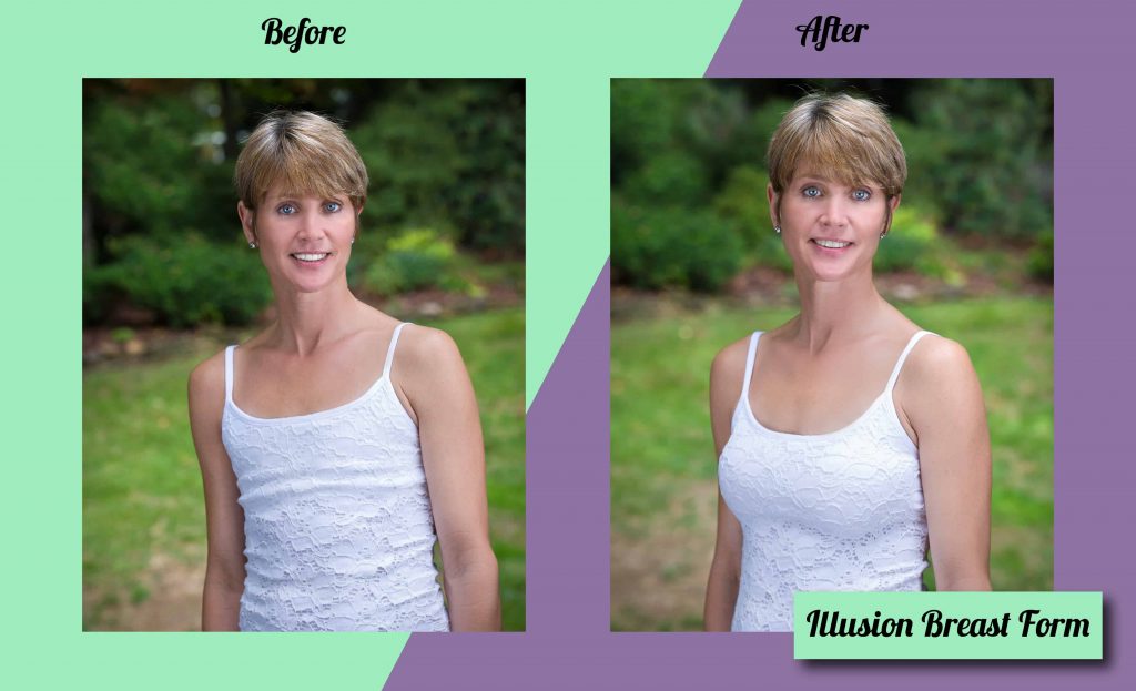 Still You Illusion Breast Forms Breast Replacements still-you-illusion-breast-forms-breast-replacements